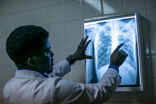 Lesotho lung xray