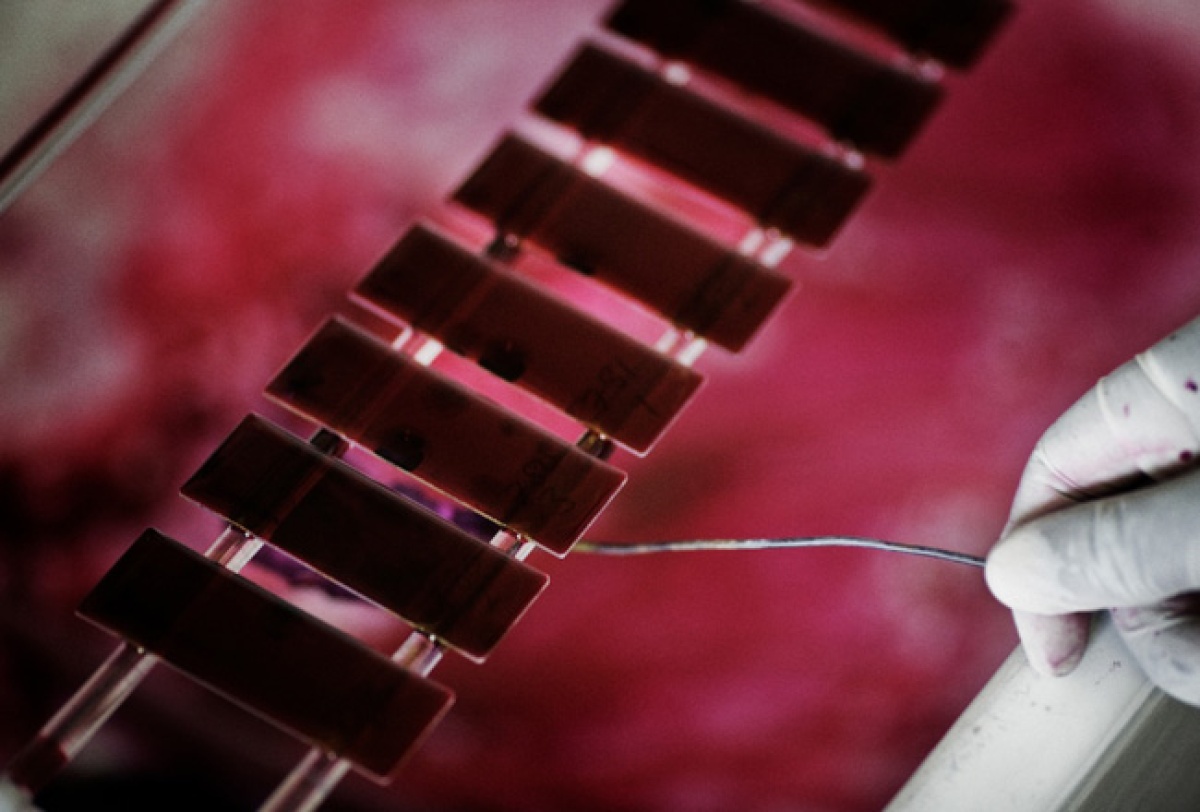 World TB Day: A Q&A With Expert Carole Mitnick